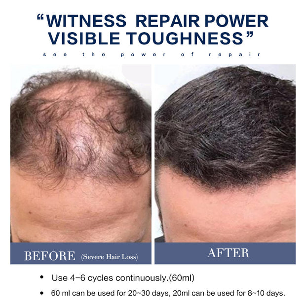 Hair Care Solution For Rapid Growth With Seborrheic Properties